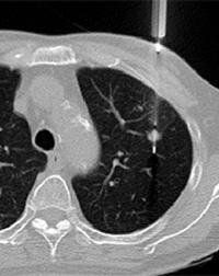 CT透視下肺生検